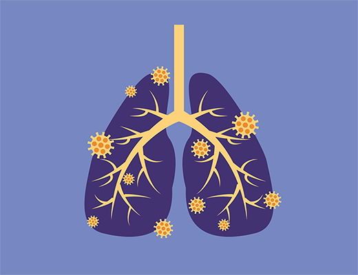 Les nouveaux enjeux de l'asthme sévère