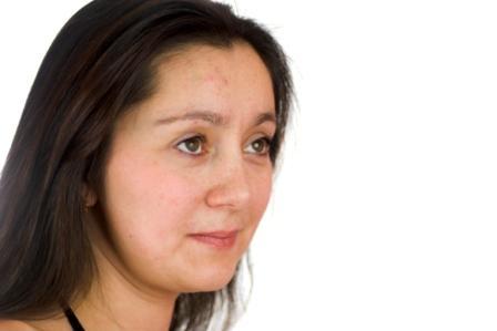 Les peaux à imperfection concernent principalement les adolescents, de manière plus ou moins sévère, pour retrouver un aspect normal, en général spontanément, à la fin de l'adolescence.