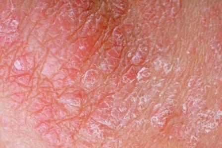 Plus fréquent chez les personnes de peau blanche, le psoriasis concerne entre 1 et 3 % de la population